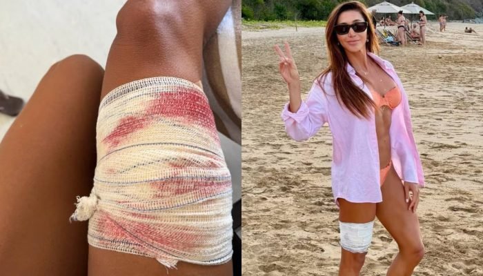 turista-e-mordida-por-tubarao-lixa-em-noronha-e-brinca-deve-estar-sem-dente